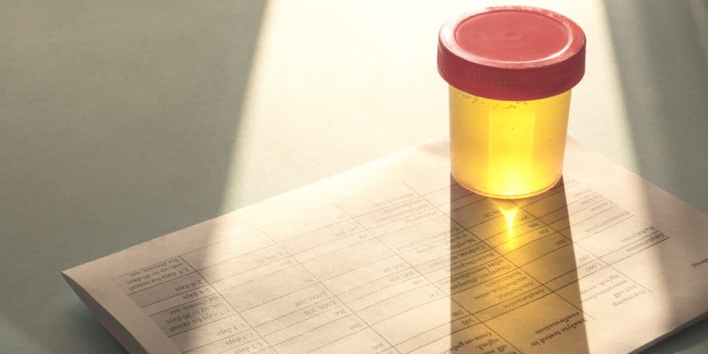 ciemne zabarwienie moczu, mocz w probówce